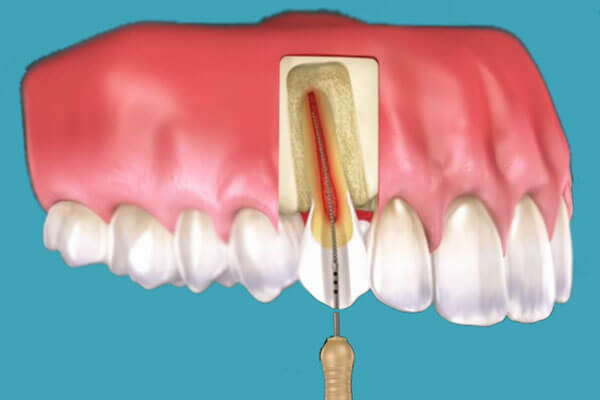 Endodonție Timisoara